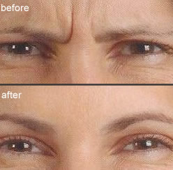 botox